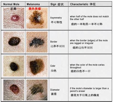 痣很凸|为什么身上突然长出新痣？容易恶变吗？